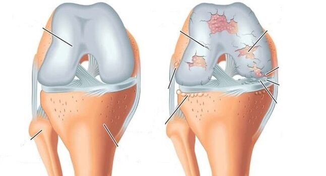 здоровый сустав и остеоартроз коленного сустава
